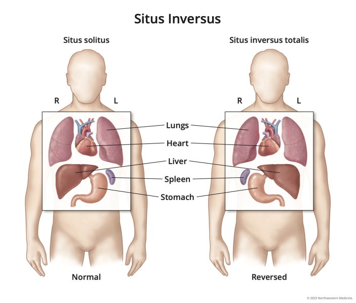 Situs inversus: an inversion of the organs placed in mirror