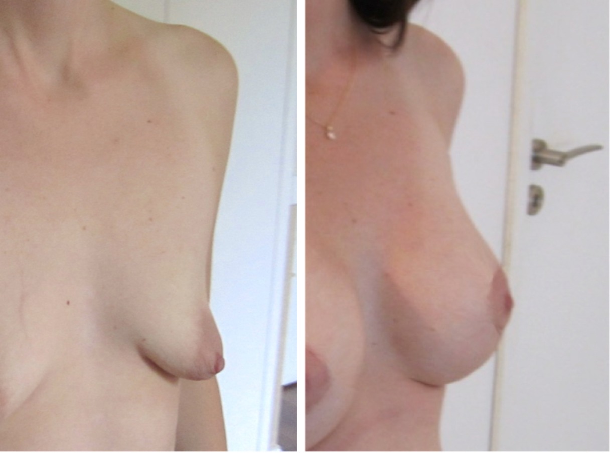 Correction d’une malformation des seins tubéreux (stade 3) par pose d’implants avec plastie mammaire (avec l’aimable autorisation du Dr Picovski)
