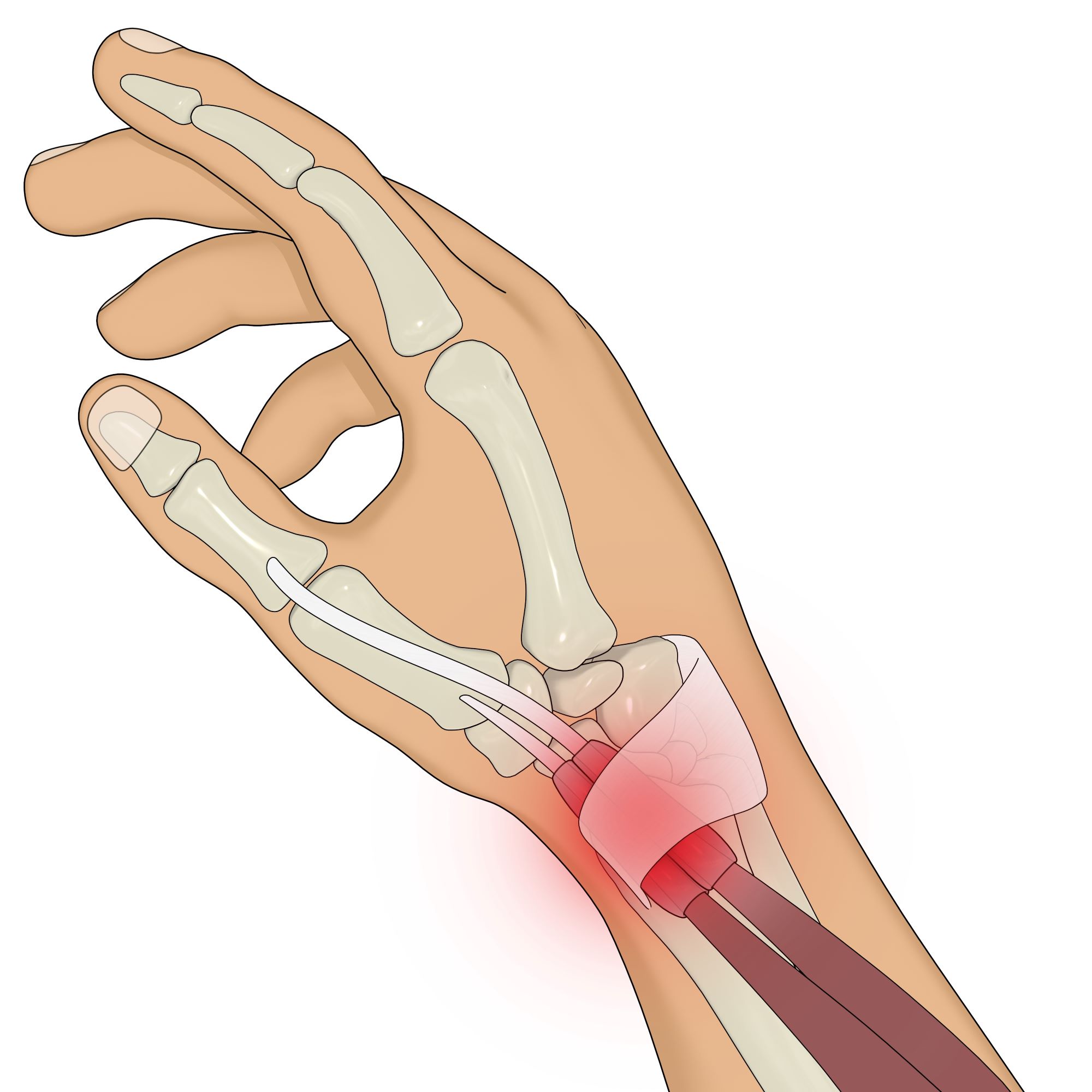 Tendinite du poignet : Symptômes, causes et traitements