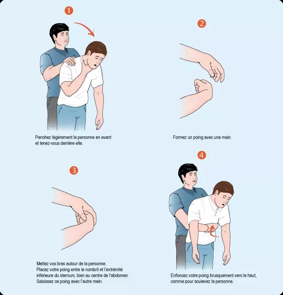 Schematic of the Heimlich maneuver