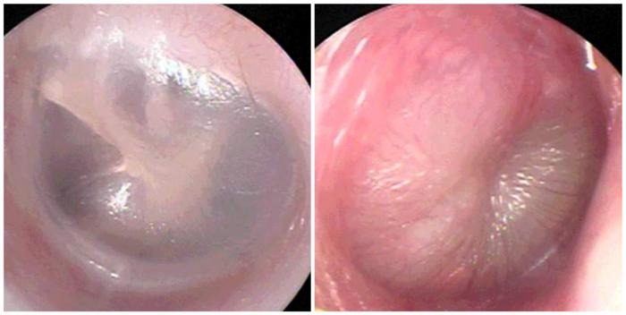 Images of the eardrums of a healthy patient (left) or suffering from acute otitis media (right) captured by the new smartphone application.