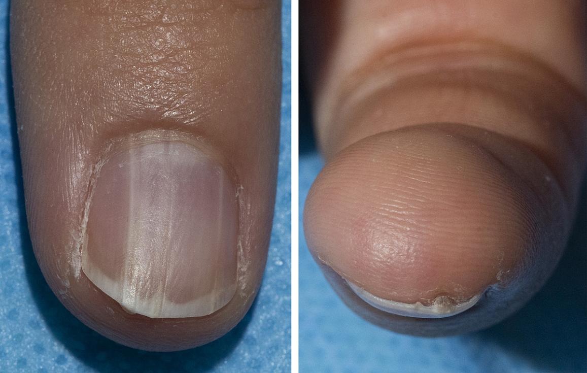 A nail affected by onychopapilloma.  Dermatology consultation service, NIAMS