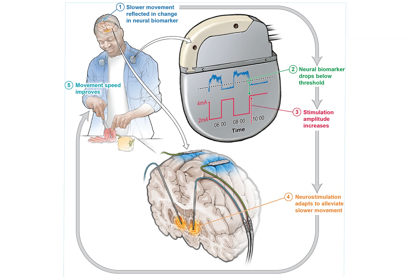 L’appareil implanté réagit aux changements des signaux cérébraux, en ajustant la quantité de stimulation tout au long de la journée, permettant aux individus de vaquer à leurs activités quotidiennes.