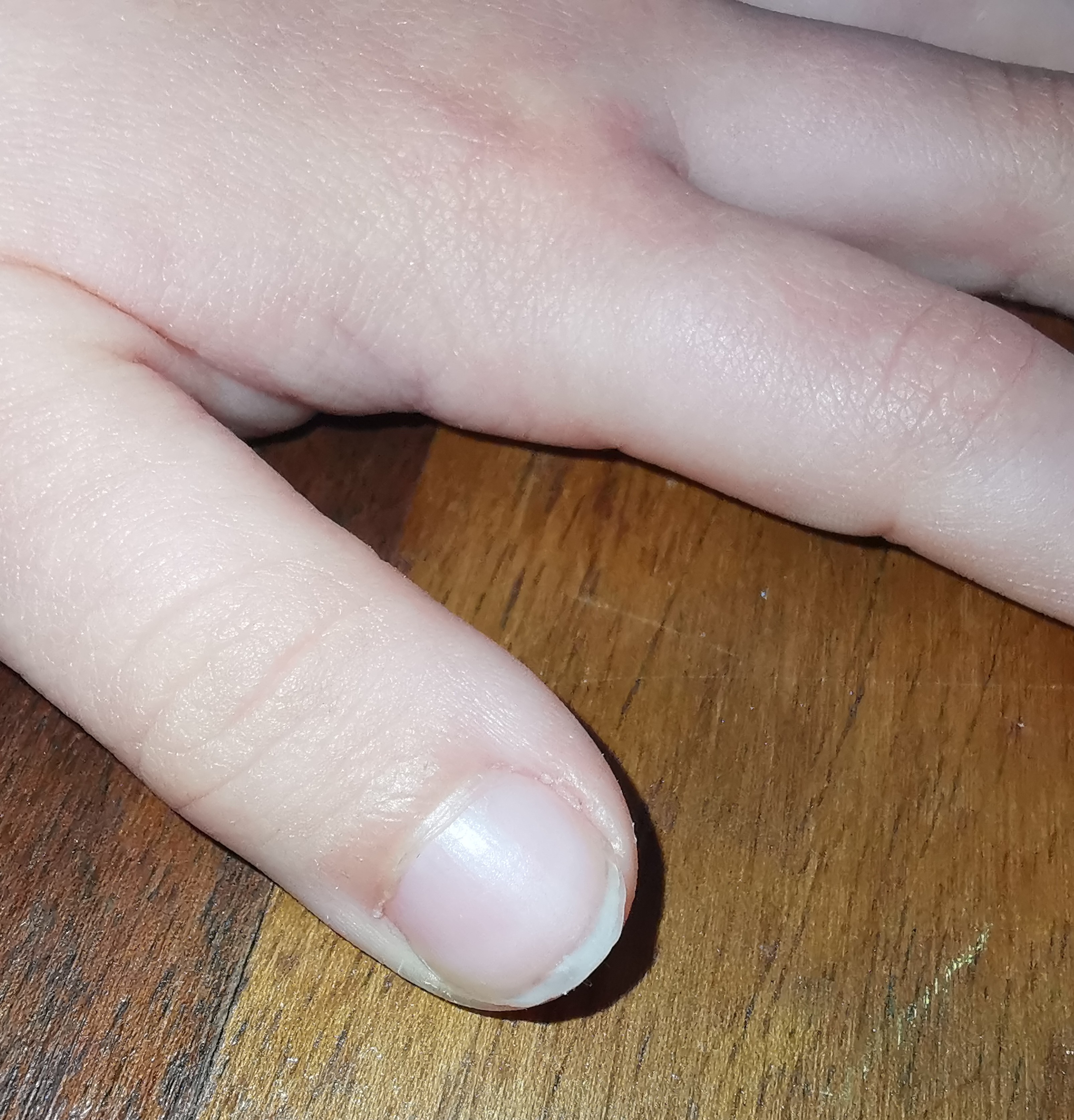 Woman With a Faint Line in Her Finger Nail Discovers She Has Melanoma