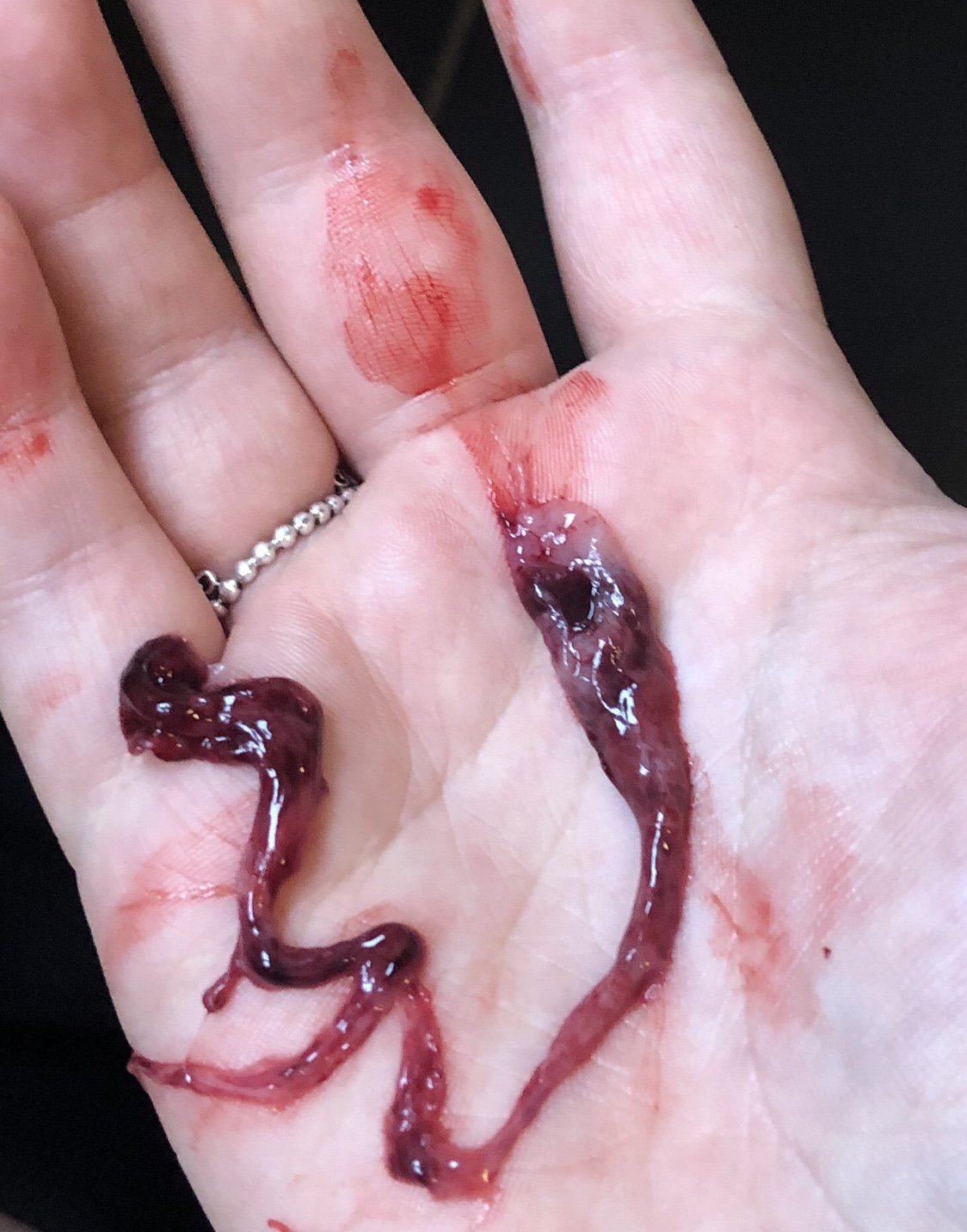5+4 passing clots/tissue (graphic photo)