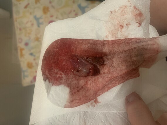 passing tissue with first period *graphic pic* - Miscarriage