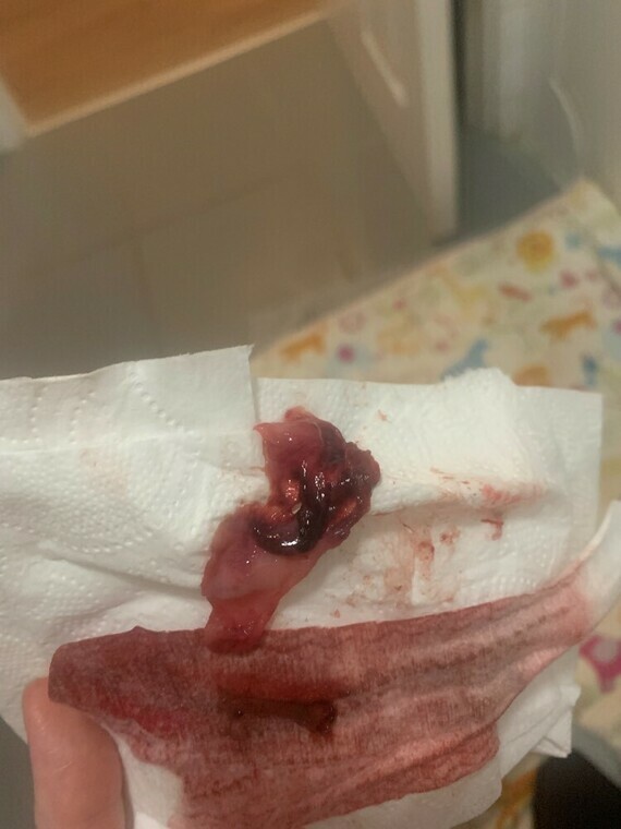 TW graphical image - is this blood clot or is this miscarriage