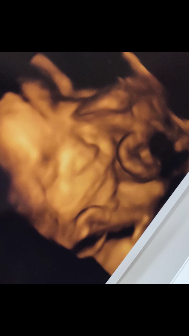 Anyone had a 4D scan at 24/25 weeks? - Page: 2