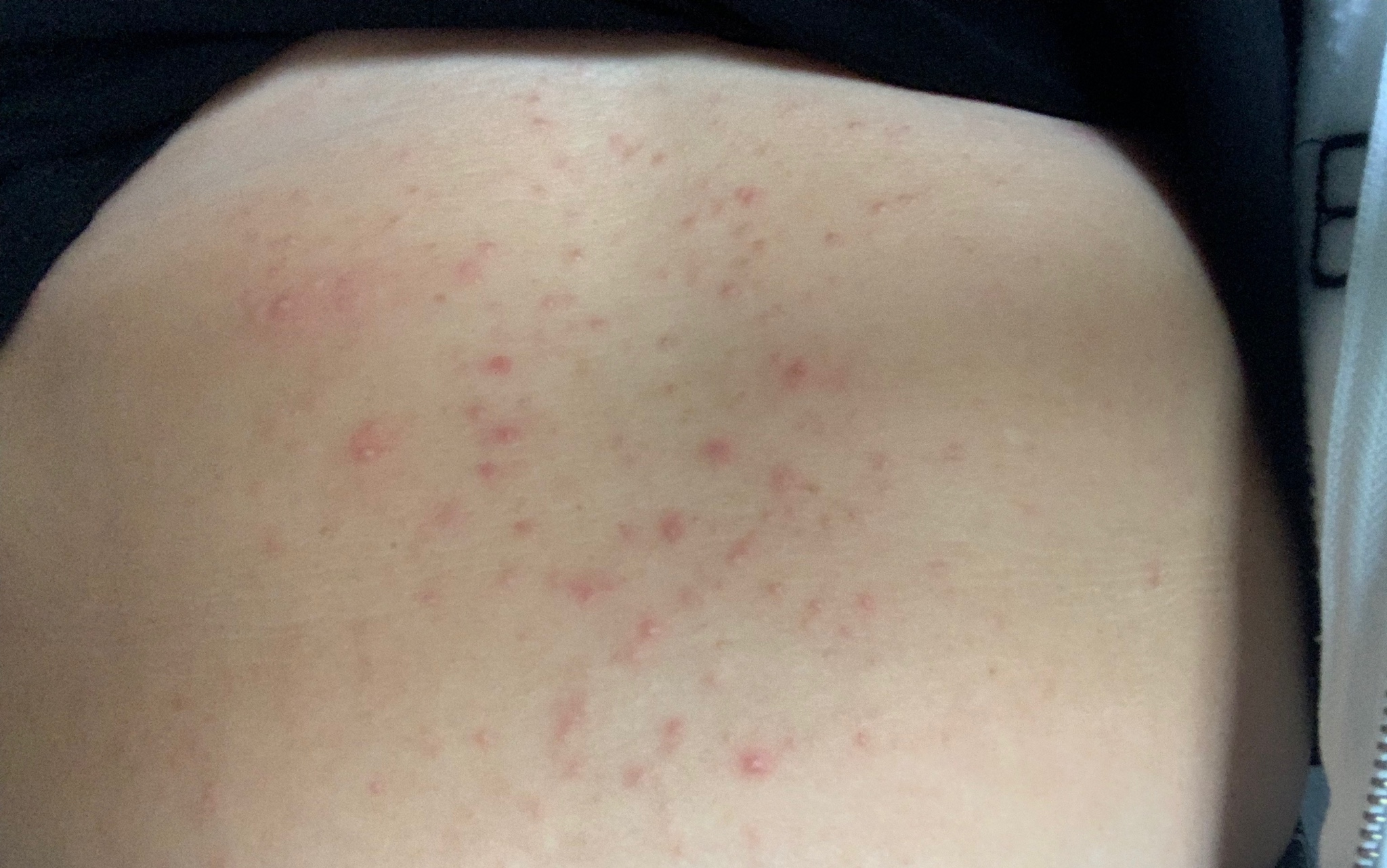 Rash Photo Anyone Had Anything Similar