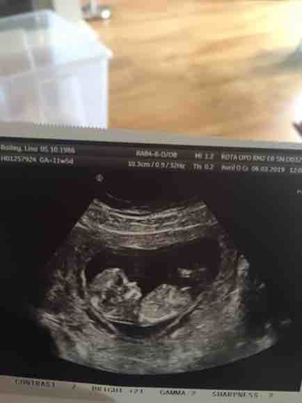 Help! Can you guess the gender (12 week scan)