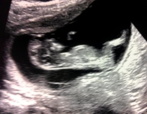 12 week scan...