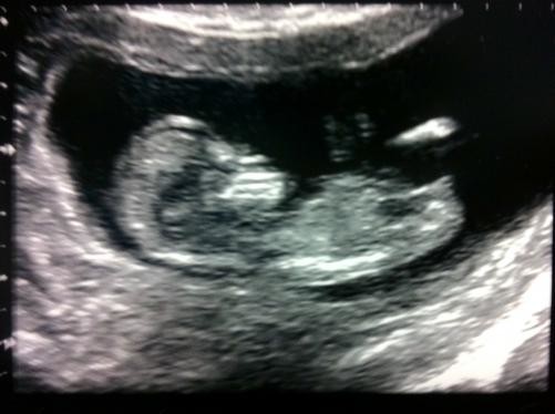 12 week scan...