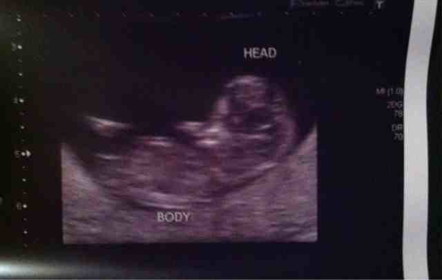10 Week Scan.......any pictures?