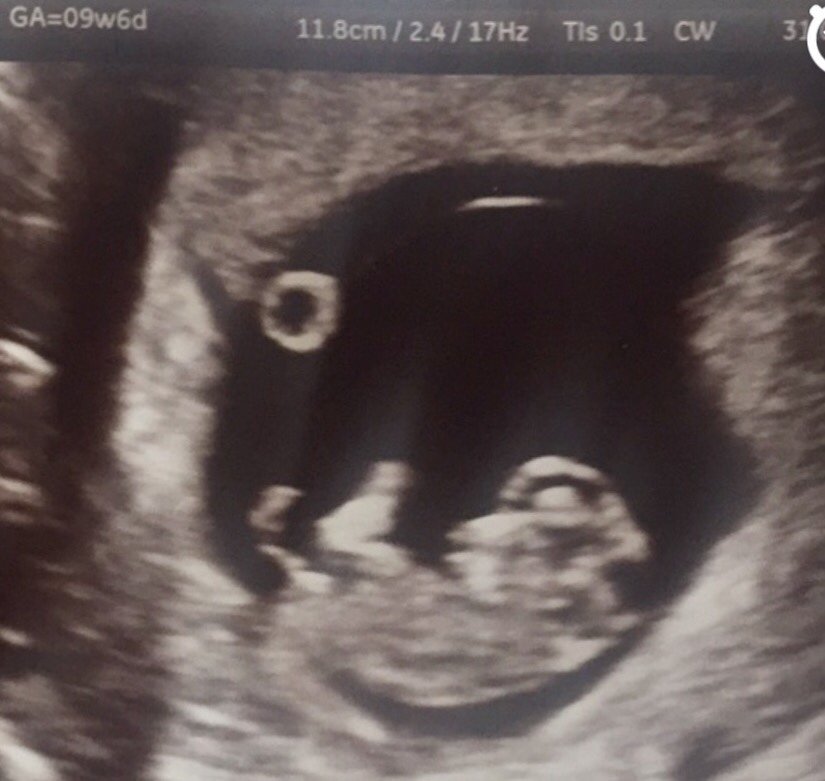 8 Weeks Scans - Can i see your pictures please