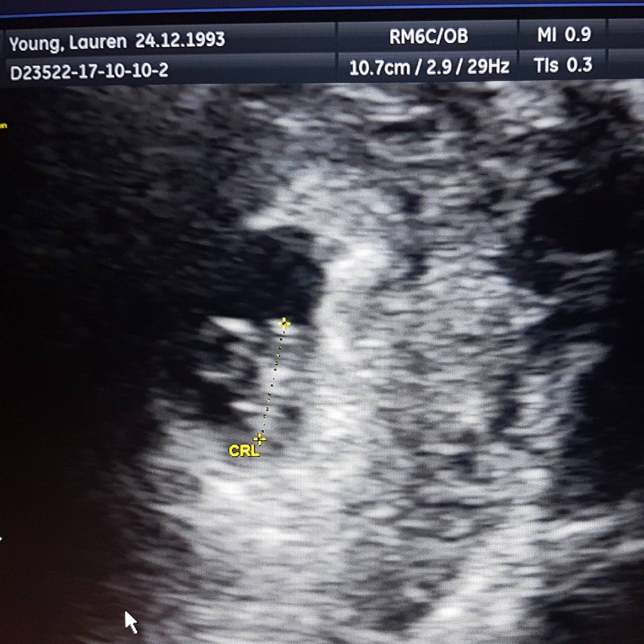 What does an early scan look like at 6 weeks and can you hear a