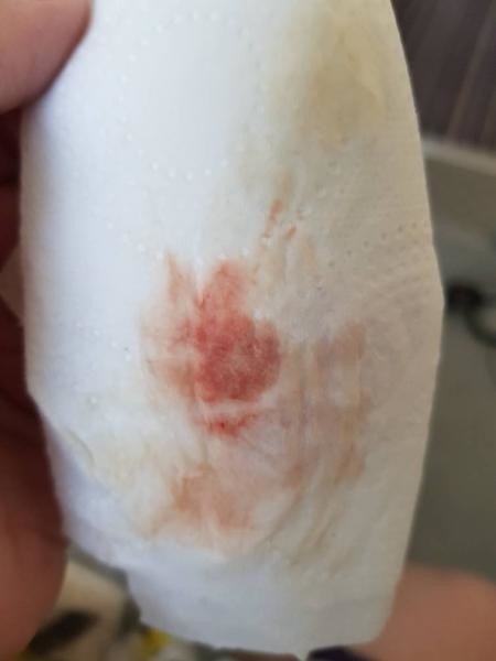 Is this implantation bleeding or AF?* - Pregnancy and Par
