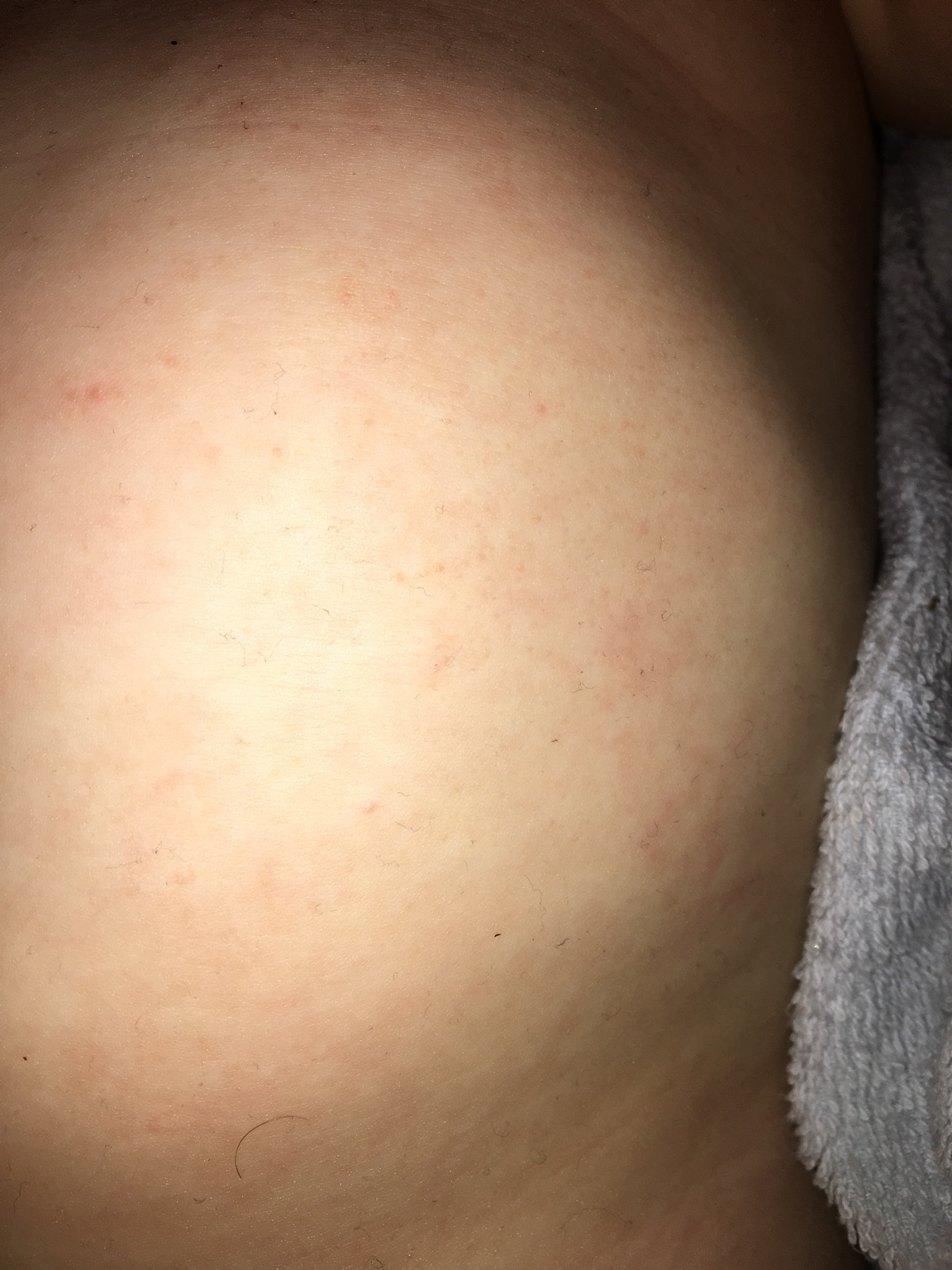 11 month old rash- pictures in post