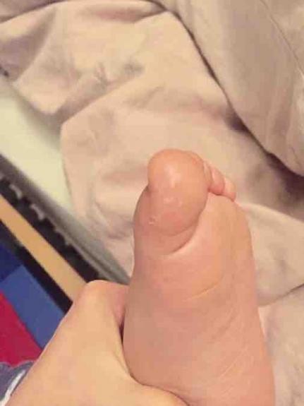 Flaky Skin Blisters On Toddler S Feet