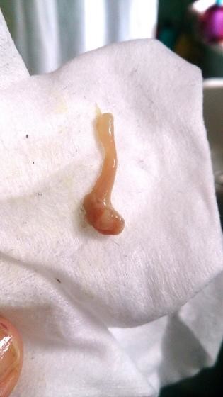 Brown Jelly Like Discharge - 1st Trimester Experiences, Forums