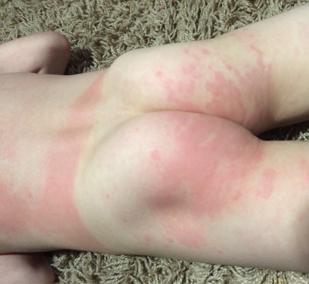 viral rashes in babies