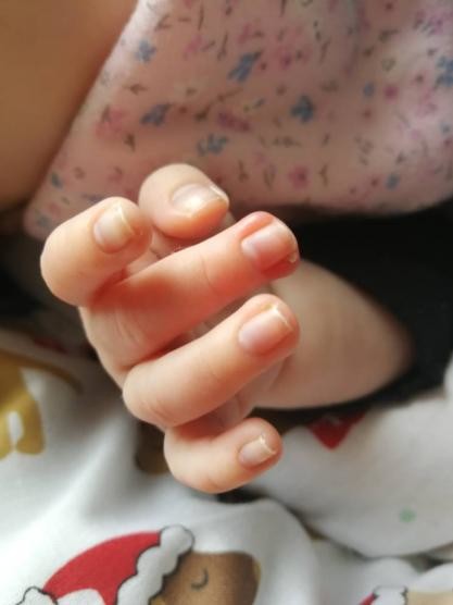 Newborn Skin Peeling on Face and Body: What Should Parents Do?