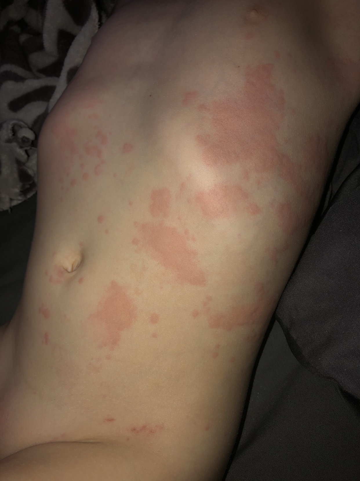 3-year-old-rash