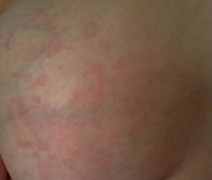 Picture included: Exclusively pumping itchy rash on breasts