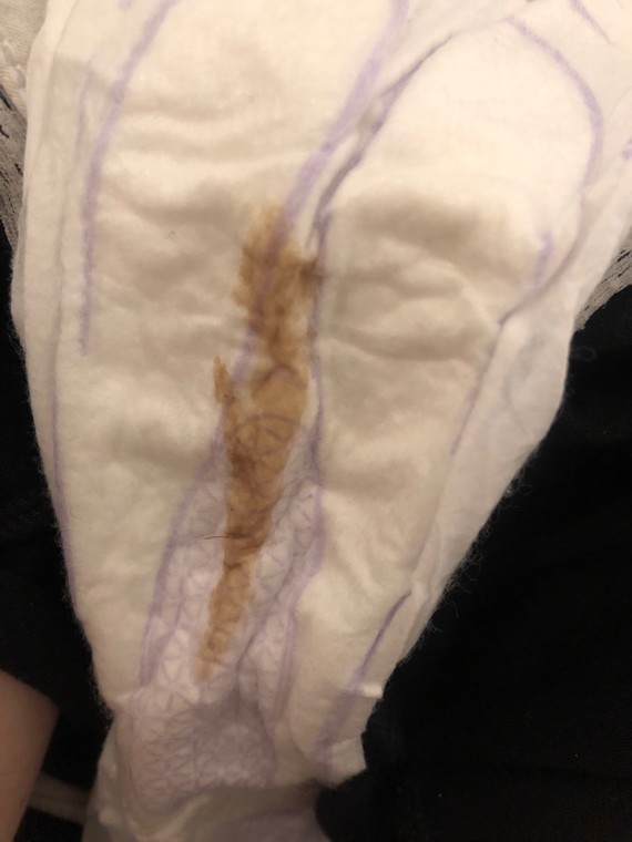what does brown implantation bleeding look like on a pad
