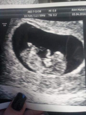 10 week scan picture! Can I see an arm?