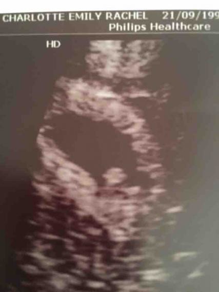 Scan at 6 weeks