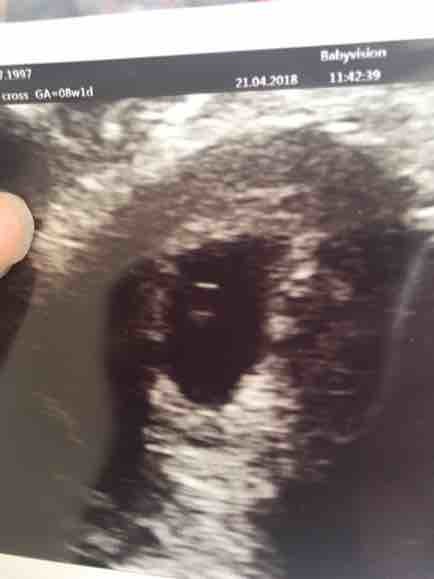 Early Pregnancy Scan At 5 Weeks But Empty Sac - Page: 2