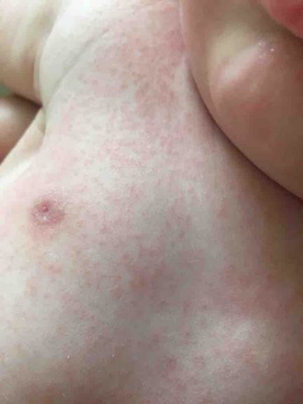 Rash on boobs (pic included) - October 2023 Babies, Forums