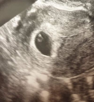 8 Week Scan