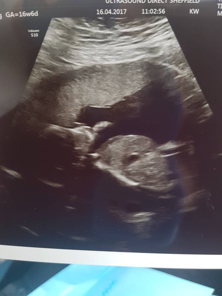 How accurate is an early gender scan?