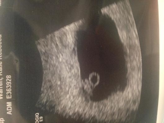 At how may weeks can you see what on an early scan