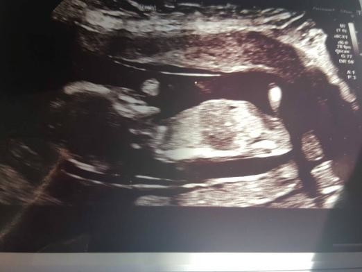 Gender scan at 16 weeks