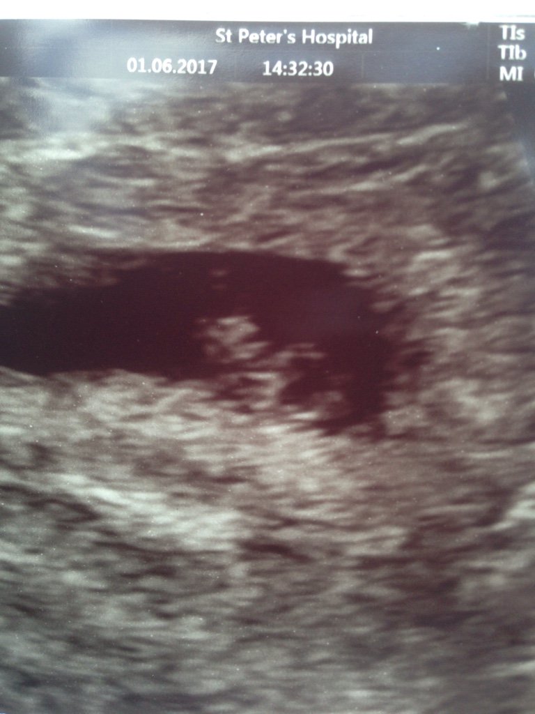 7-weeks-pregnant-ultrasound-pockethealth