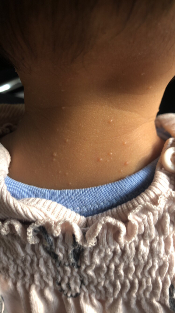 tiny-spots-on-baby-neck-and-face