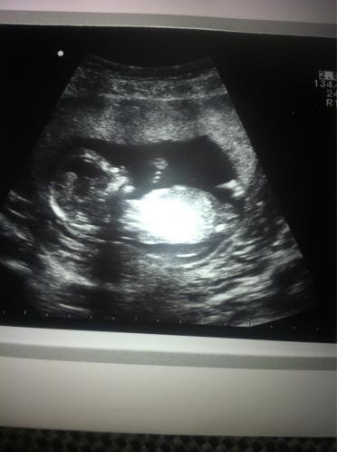 12 Week Scan!