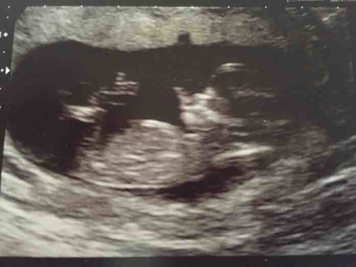 12 Week Scan Gender