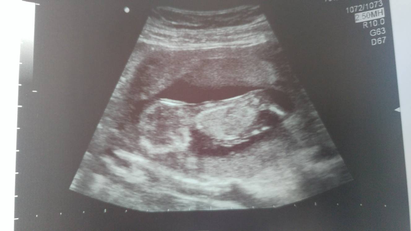 My 12 week scan on Monday... - Page: 2