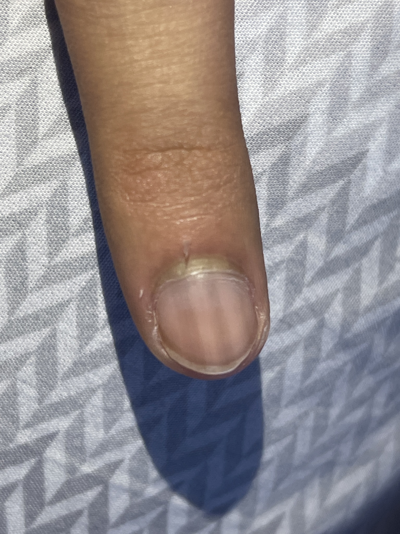 If You Have This Mark on Your Nail, You Should Get Checked for Cancer