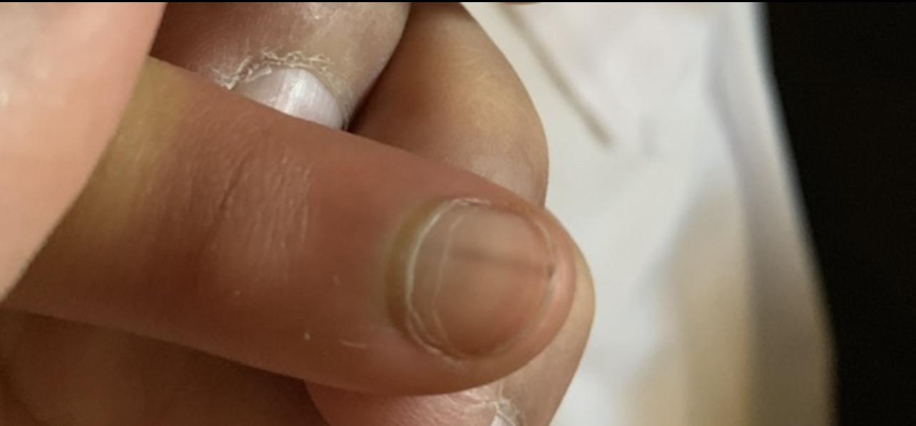 Woman Loses Thumb to Skin Cancer Caused by Nail Biting | Allure