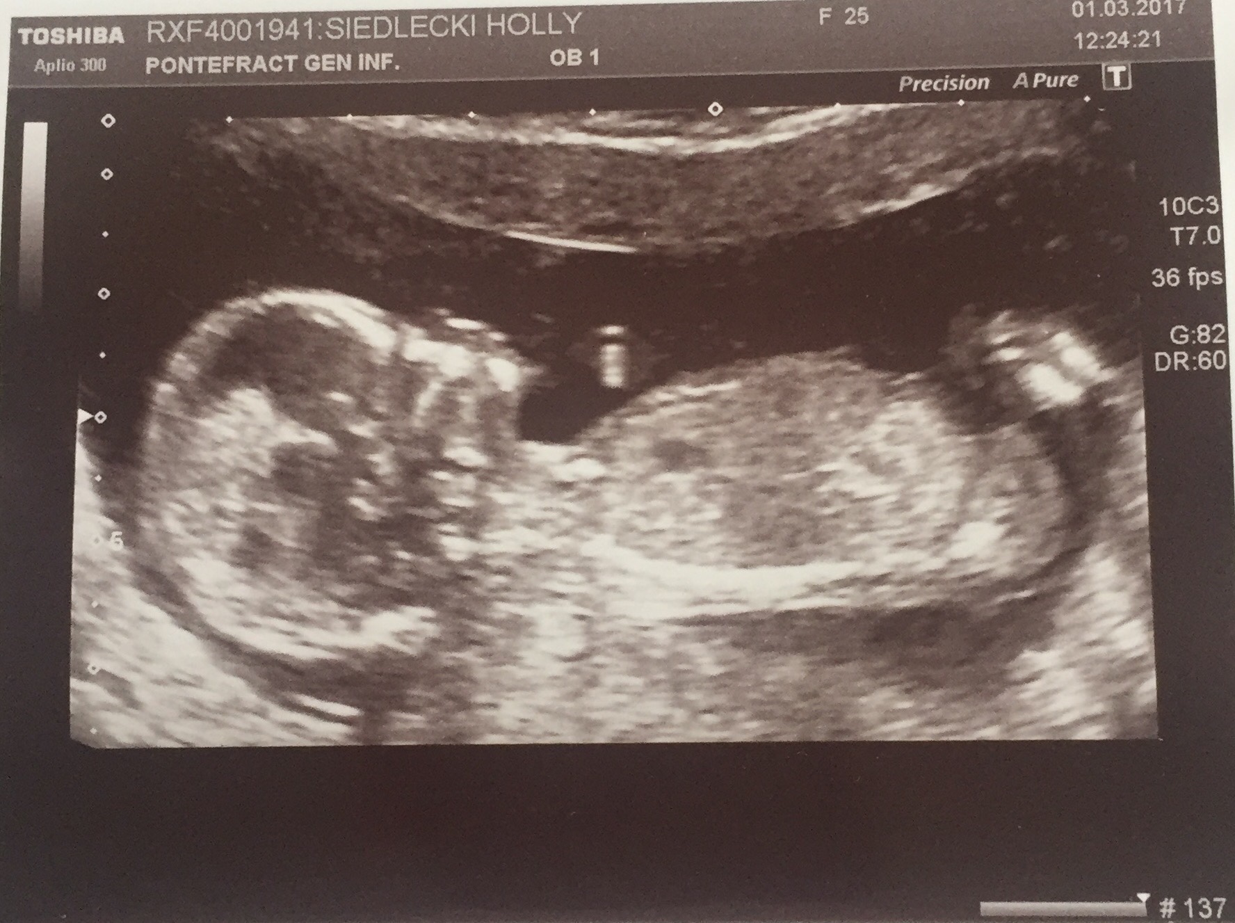 Has anyone had their 20 week scan before they're actually 20 weeks?