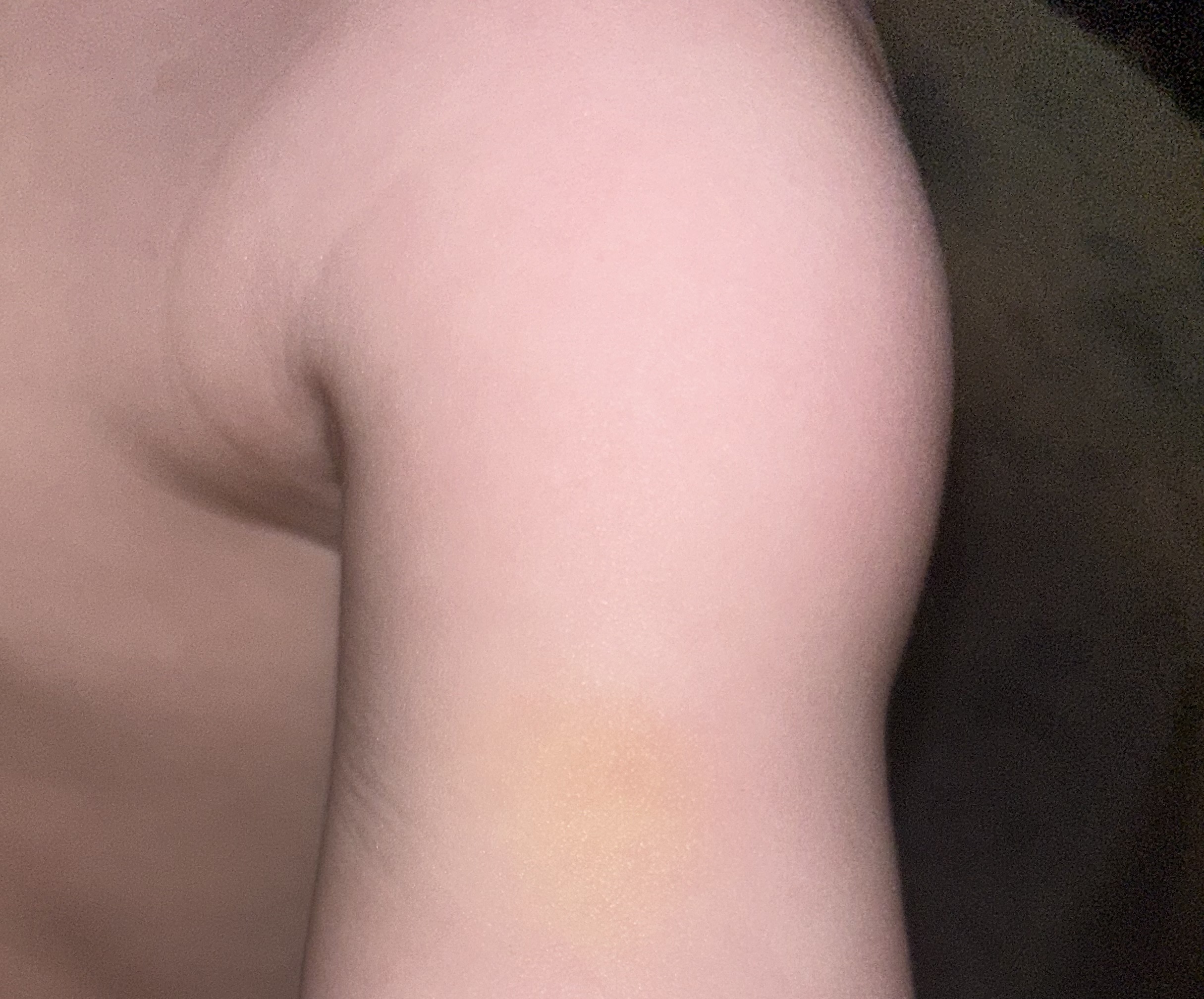 bruise on upper arm