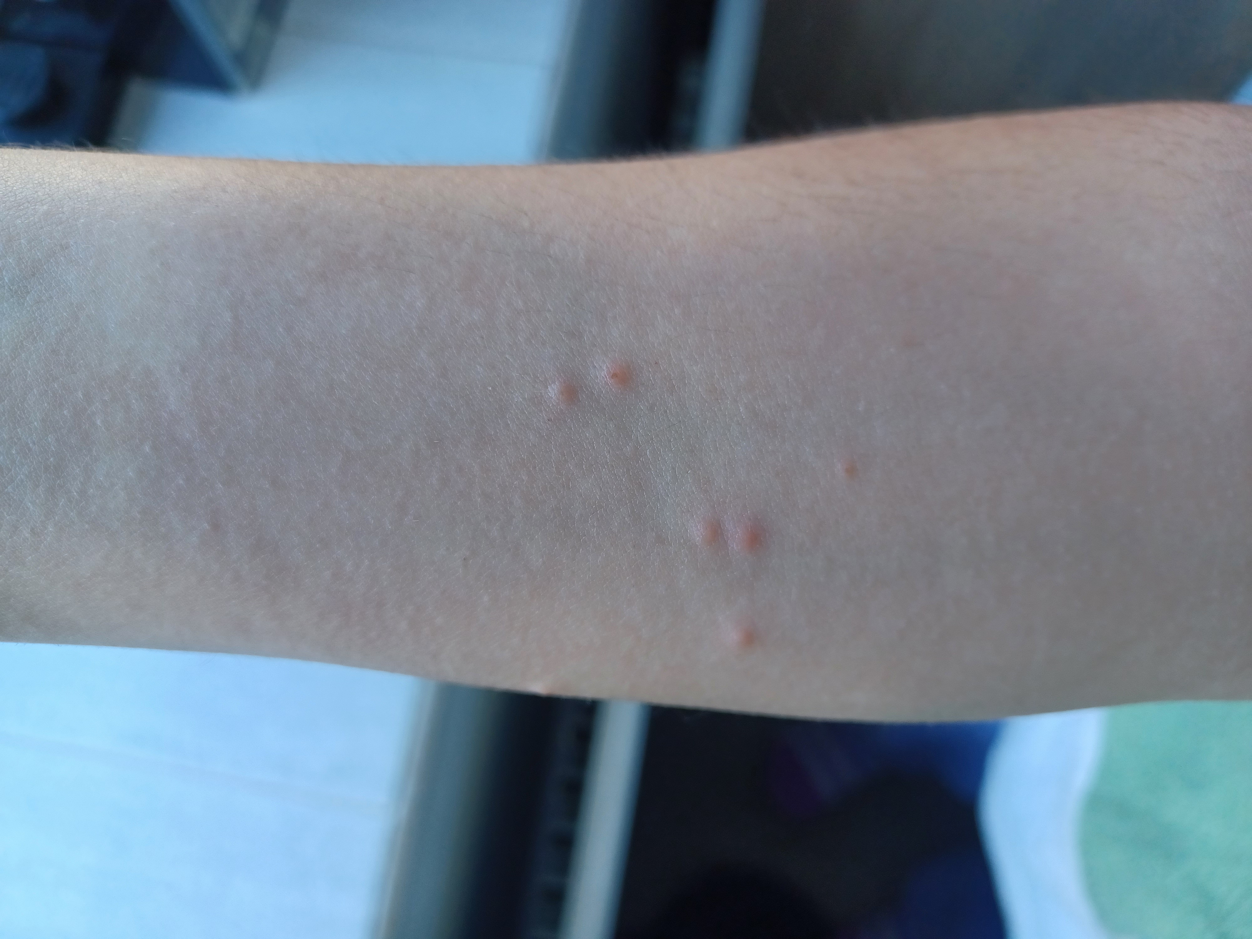 Funny Rash Rash On Right Arm During Pregnancy